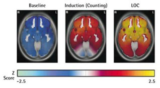 Masimo - Schéma des variations de la puissance de l’EEG mettant en évidence des changements dans la puissance de l’EEG au moment de l’induction de l’anesthésie et de la perte de conscience